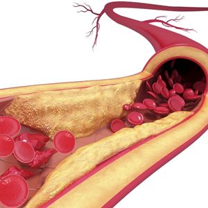 Ateroskleroza; Атеросклероза