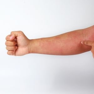 Dermatitis; Дерматитис